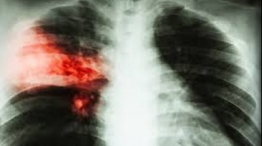 La tuberculosis regresó como principal enfermedad infecciosa mundial