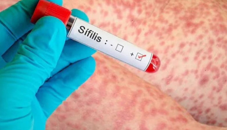 TDF es una de las provincias donde se registran más casos de sífilis